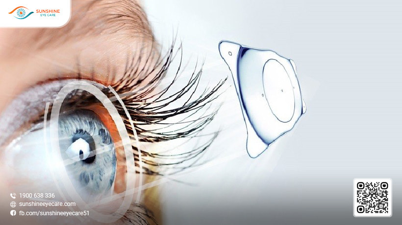 công nghệ mổ mắt cận thị mới nhất