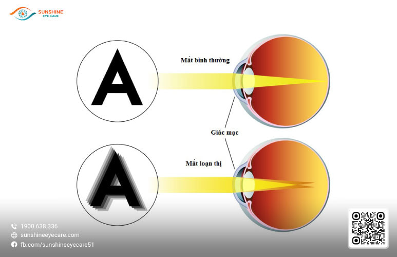 mắt tật khúc xạ là gì