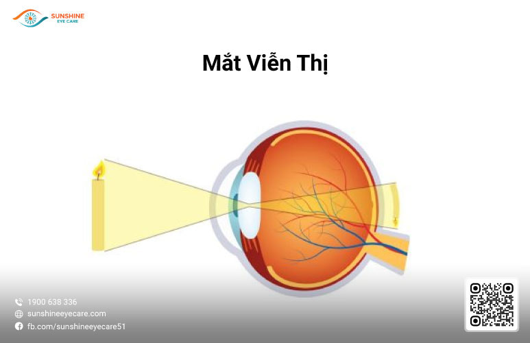 tật khúc xạ ở mắt là gì