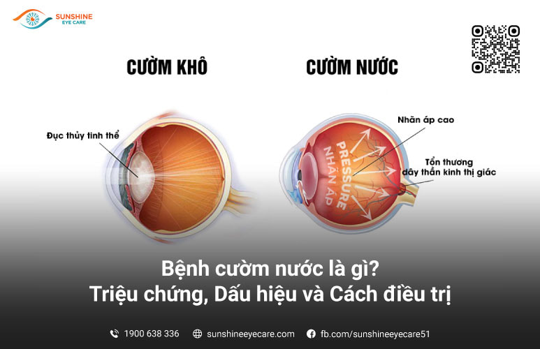 bệnh cườm nước