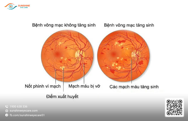 bệnh võng mạc tiểu đường