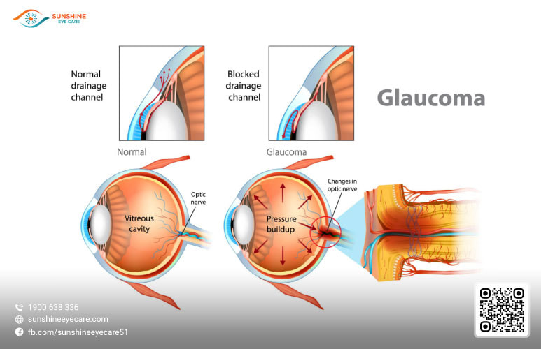 glaucoma là gì