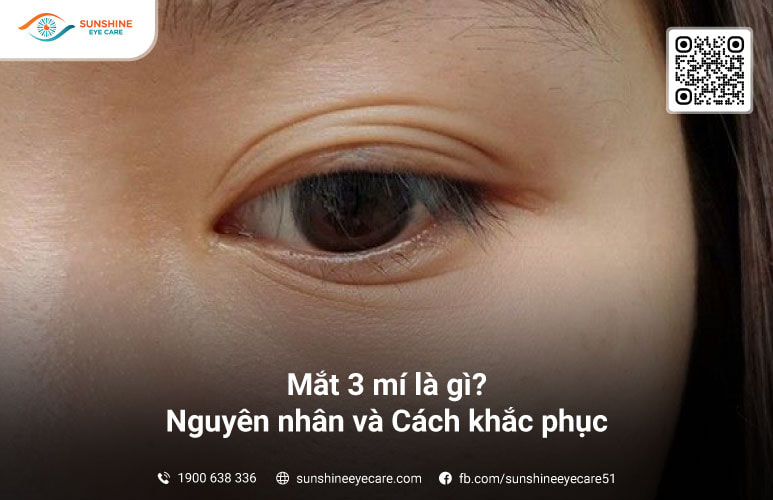 Khắc phục mắt 3 mí tại nhà