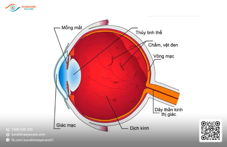 mắt hay bị mờ như có màng che