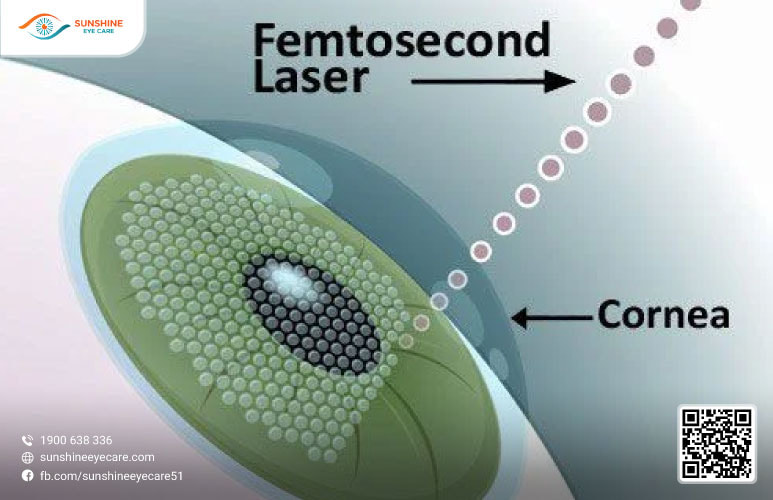 mổ cận femto lasik