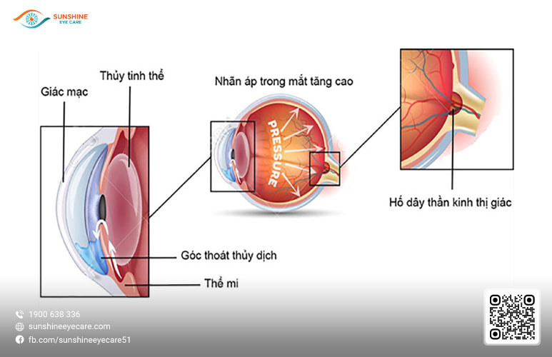 nguyên nhân tăng nhãn áp