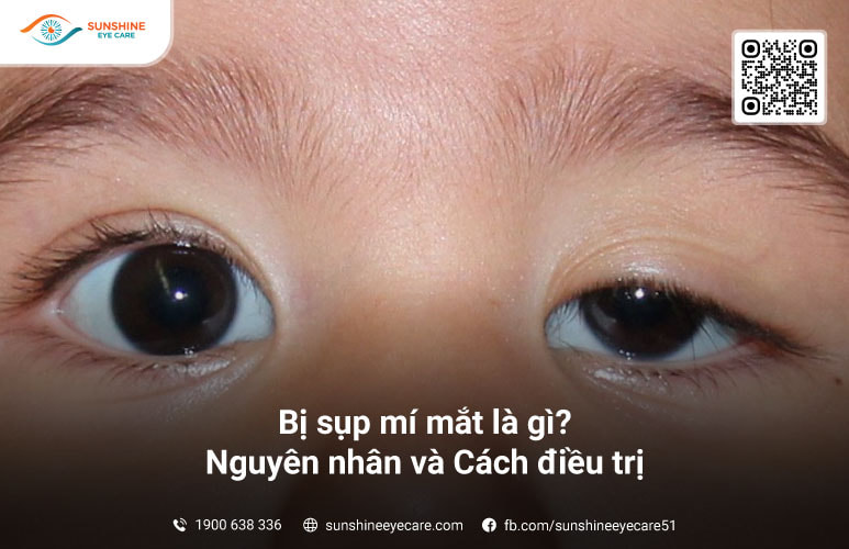 sụp mí mắt