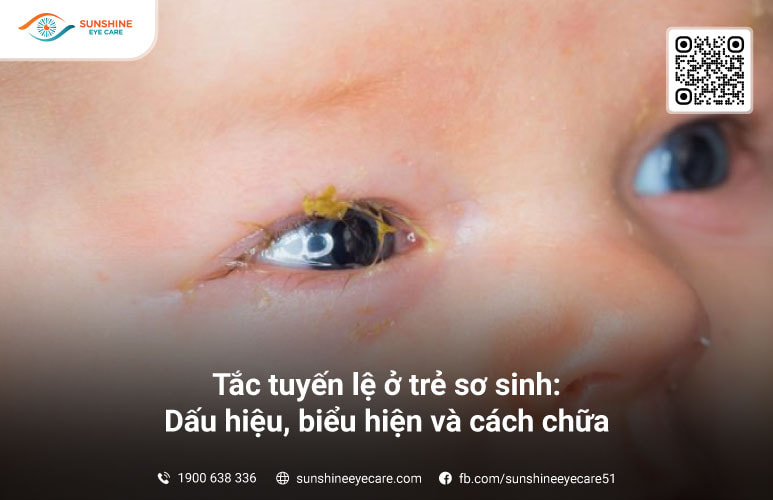 tắc tuyến lệ ở trẻ sơ sinh