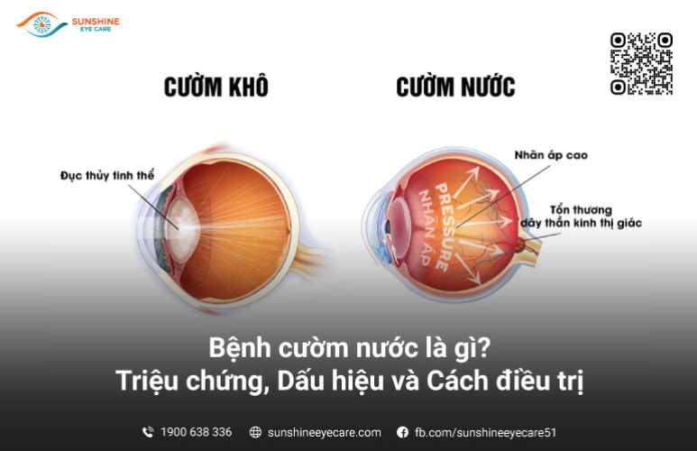 Bệnh cườm nước là gì? Triệu chứng, Dấu hiệu và Cách điều trị