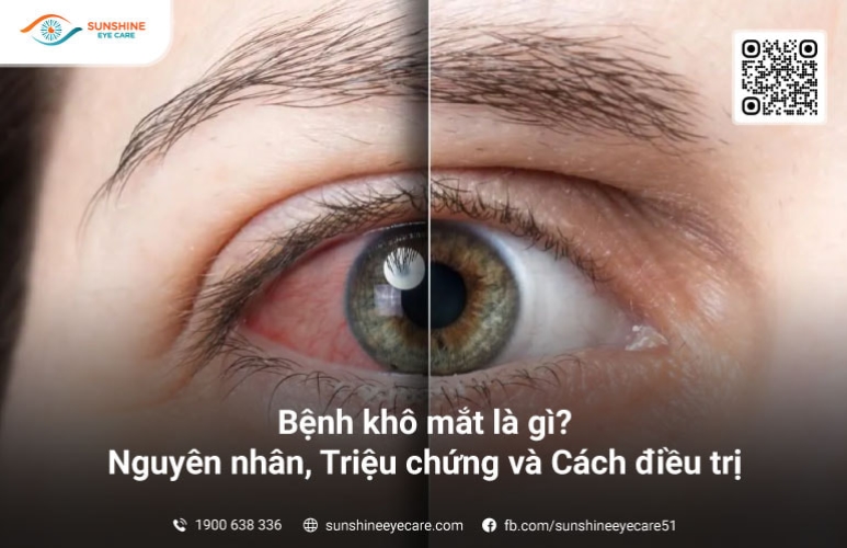 Bệnh khô mắt: Nguyên nhân, Triệu chứng và Cách điều trị