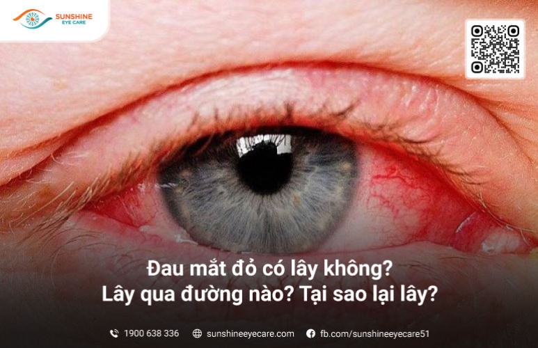 Đau mắt đỏ có lây không? Lây qua đường nào? Tại sao lại lây?