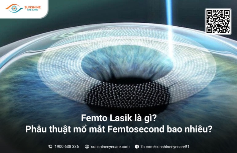 Femto Lasik là gì? Phẫu thuật mổ mắt Femtosecond bao nhiêu?