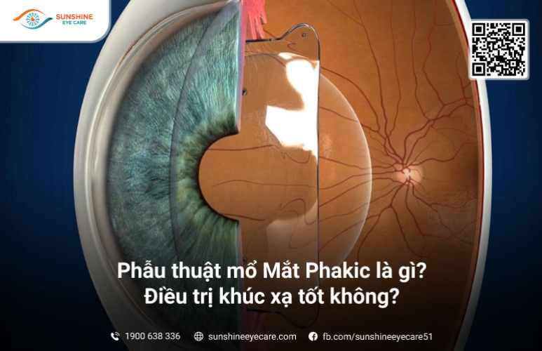 Phẫu thuật mổ Mắt Phakic là gì? Điều trị khúc xạ tốt không?