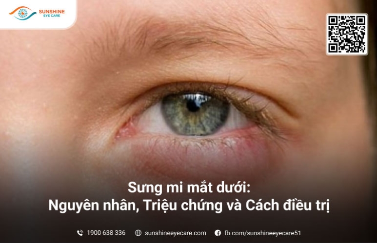 Sưng mí mắt dưới: Nguyên nhân, Triệu chứng và Cách điều trị