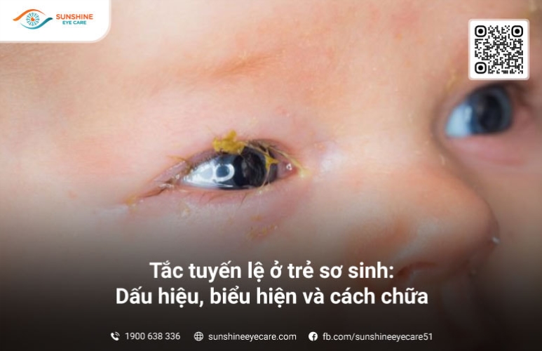 Tắc tuyến lệ ở trẻ sơ sinh: Dấu hiệu, biểu hiện và cách chữa