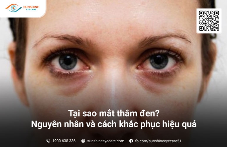 Tại sao mắt thâm đen? Nguyên nhân và cách khắc phục hiệu quả