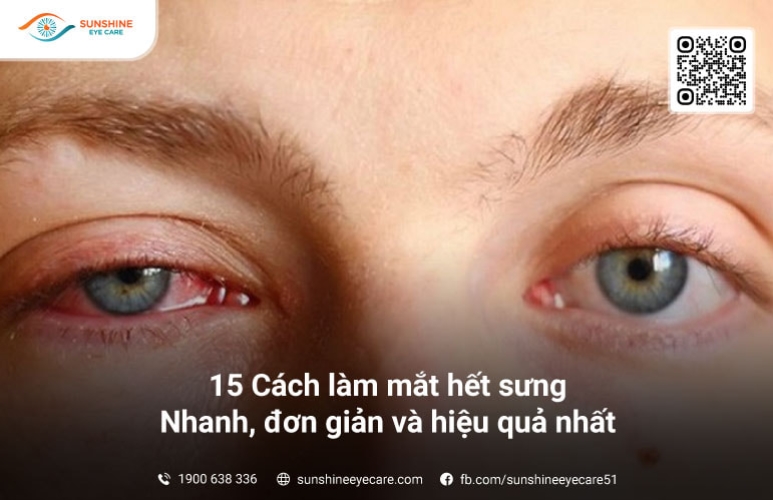 Cách làm mắt hết sưng nhanh nhất: Phương pháp hiệu quả và đơn giản tại nhà